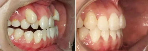 镶牙和牙套的区别[镶牙与牙套的区别]
