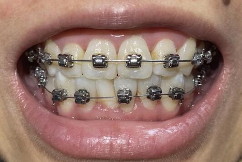 牙面上有黑色怎么办(如何应对牙面上的黑色问题？)