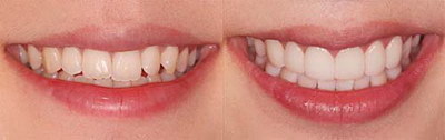 牙齿松松的怎么办_拔牙齿后多久可以装假牙齿