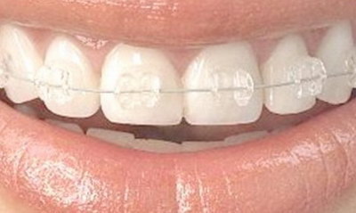 多少岁牙齿开始老化(人的牙齿一般多少岁开始掉)