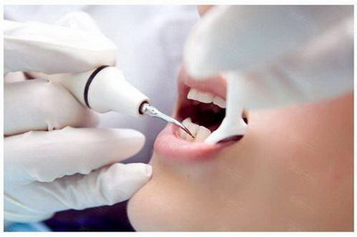 牙齿缺口怎么修复