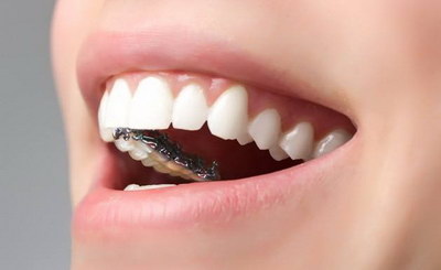 带牙套能治疗磨牙吗