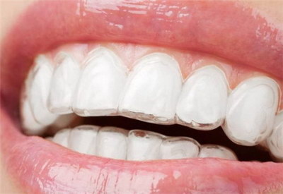 树脂材料修补牙齿