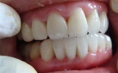牙齿整形有几种方法