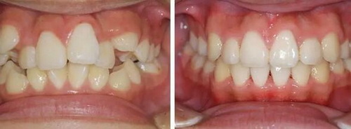 为什么不建议树脂补牙_为什么树脂补牙后底部是黑的