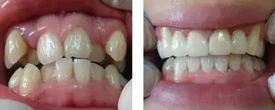 做牙齿整形手术以后需要注意哪些_何时是最佳的牙齿整形手术时机?