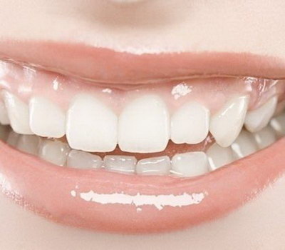 牙齿变黄还能刷白吗