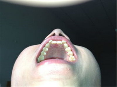 日本纳米树脂补牙和3m