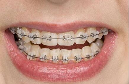 3m牙套和普通牙套有啥区别(烤瓷牙套和普通牙套的区别)