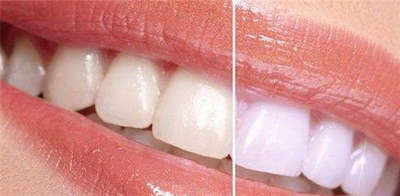 洗牙会伤害牙釉质么