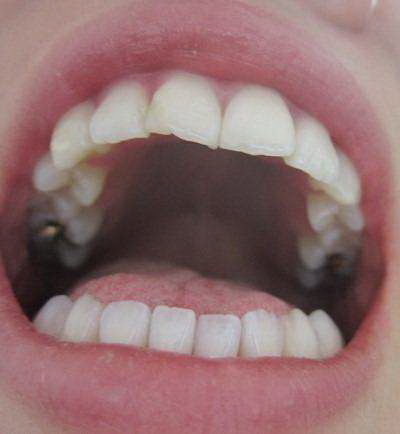 戴了牙套多久可以正常吃饭(根管治疗牙套多久可以正常使用)