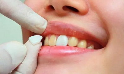 带牙套矫正牙齿的过程