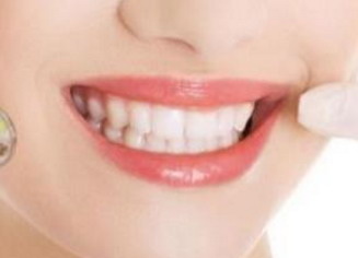 牙齿美白多少钱一颗「牙齿美白贴片多少钱一颗」