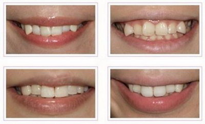 矫正牙齿钢丝和隐形的哪种好_矫正牙齿必须用正畸牙刷吗