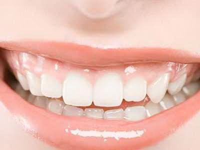 牙贴面有哪些类型【牙贴面有哪些种类】