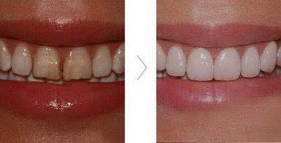 下颌第一磨牙素描(右下颌第一磨牙素描图)
