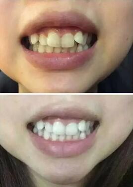 广州哪家种牙比较好_拔牙后三个月可以种牙吗