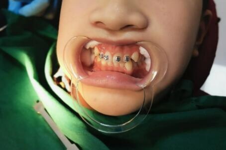 牙齿稀疏修复