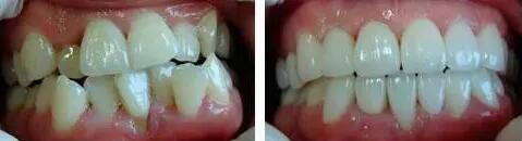 牙齿片切多少毫米(牙齿一个月移动多少毫米)