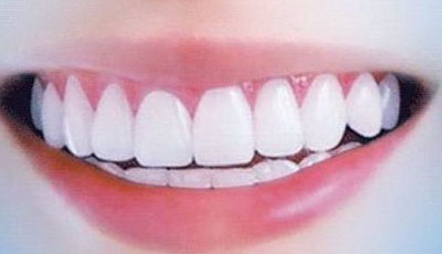 成人牙齿矫正有哪些方法