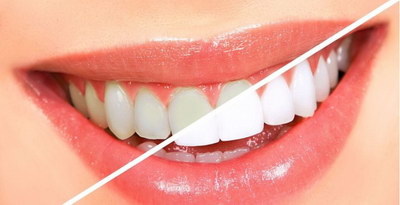 牙周炎治疗就是洗牙吗(什么是牙周炎？)