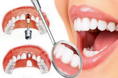 拔牙后的干燥症是什么症状_拔牙后的黑色血凝块多久能够消失