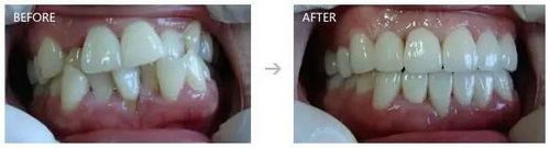 乳牙根管治疗的步骤(乳牙根管治疗图片步骤)