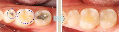 矫正完牙齿后牙缝越来越大是什么原因(矫正牙齿为什么牙缝越来越大)