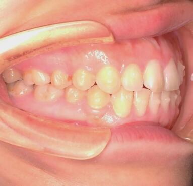牙性龅牙矫正需要多久