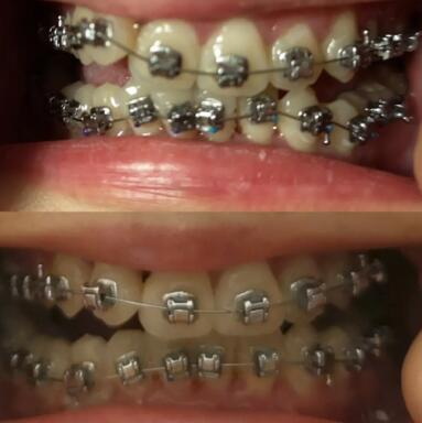 牙龈萎缩多久恢复_拔了牙牙龈萎缩可以恢复吗