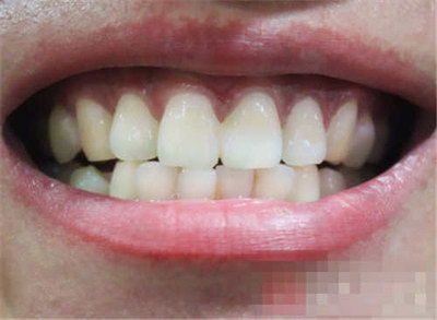 牙龈萎缩后牙齿还能用几年_牙齿矫治后牙龈萎缩