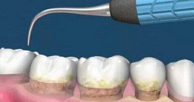 牙渍怎样快速去除_洁牙去除牙渍色素