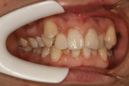 为什么牙齿缝会扣出结块_为什么牙齿缝隙里的脏东西很臭