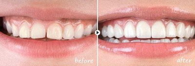 牙齿矫正效果如何_牙齿矫正的危害是什么