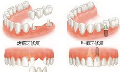 银汞合金补牙的优缺点