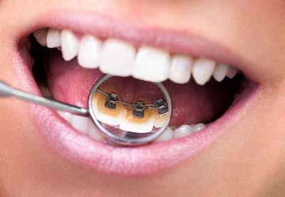 门牙矫正的时候拔牙齿有影响吗