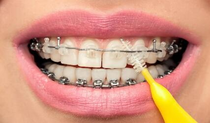 大牙龅牙能矫正吗