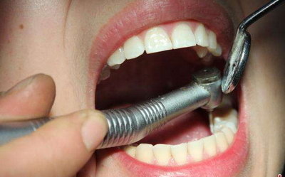 皓齿美白牙齿可以用于补牙吗_皓齿美白牙齿可以维持多久