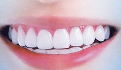 牙齿矫正有什么优缺点
