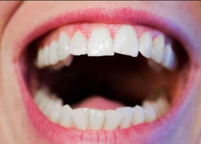 牙齿松动怎么修复最快最有效
