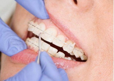 拔完智齿后多久可以恢复正常饮食_智齿拔牙缝合几天拆线