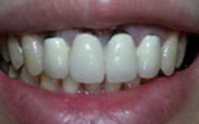 牙齿国产和进口(矫正牙齿国产和进口牙套有什么区别)