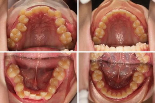 牙齿磕断能补回来吗