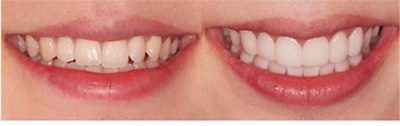 牙齿中间有一条缝_牙齿外凸什么原因
