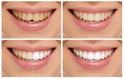 有效的处理牙齿敏感方法_牙齿怎么收缝过程