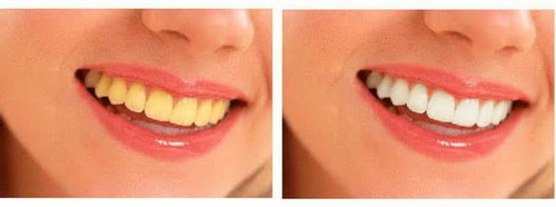 龅牙矫正牙齿的全部过程(矫正龅牙的全部过程)
