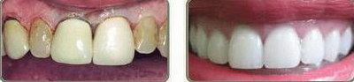 怎么看龅牙是骨性还是牙性