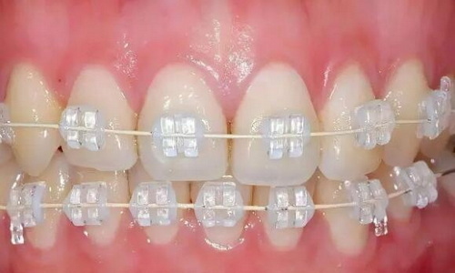 牙根管治疗过程要多久(治疗前的准备)