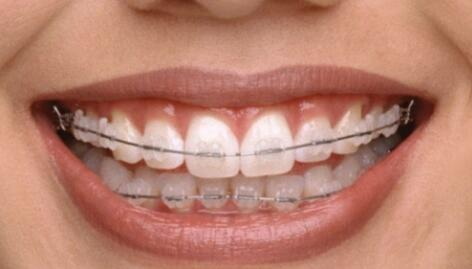 牙齿修补用什么方法