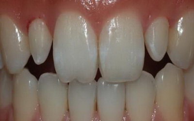 牙龈上面变成白色_牙龈炎怎么能治好